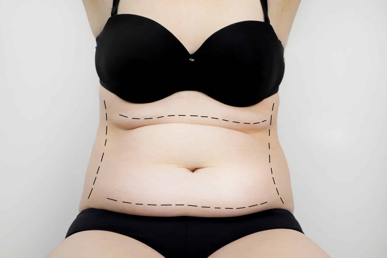 abdominoplastie